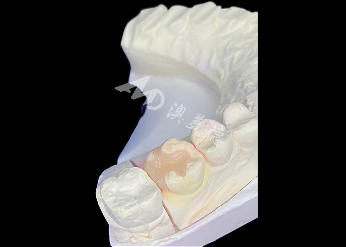 IPS e.max Các lớp phủ và lớp phủ gốm để phục hồi hàm răng miệng với kết quả thẩm mỹ và vẻ ngoài tự nhiên lâu dài