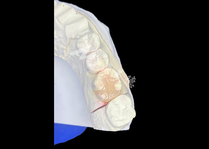 IPS e.max Các lớp phủ và lớp phủ gốm để phục hồi hàm răng miệng với kết quả thẩm mỹ và vẻ ngoài tự nhiên lâu dài