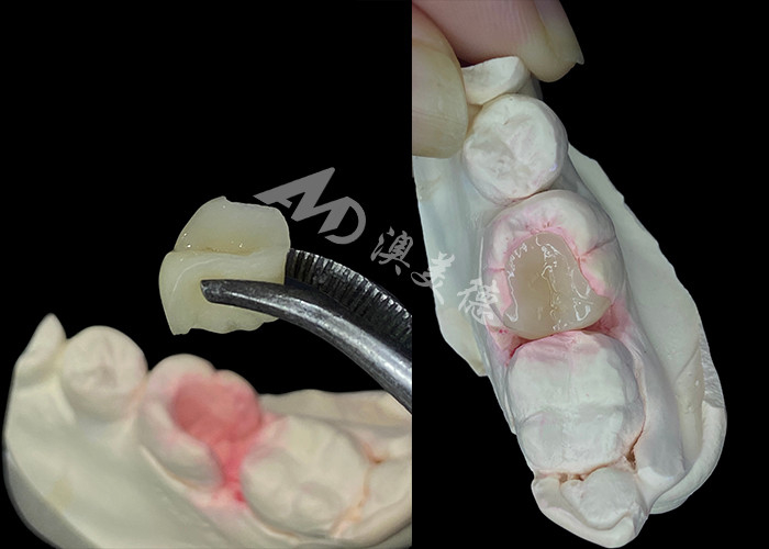 IPS e.max Các lớp phủ và lớp phủ gốm để khôi phục răng tự nhiên