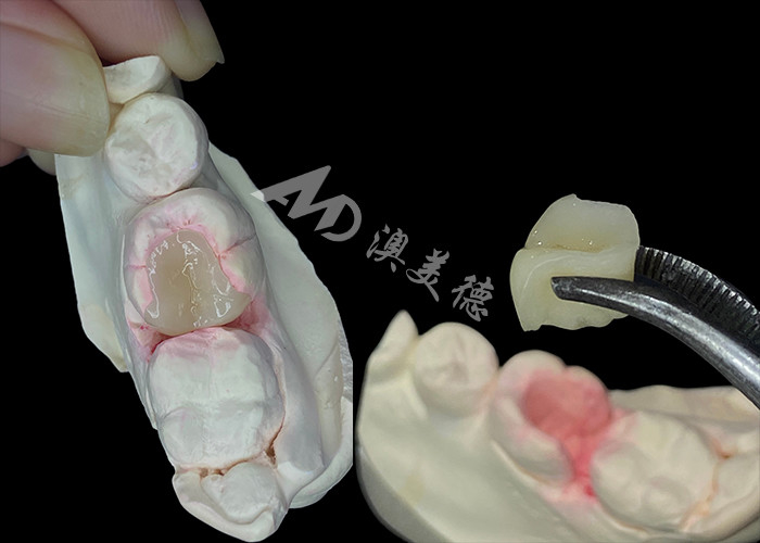 IPS e.max Các lớp phủ và lớp phủ gốm để khôi phục răng tự nhiên