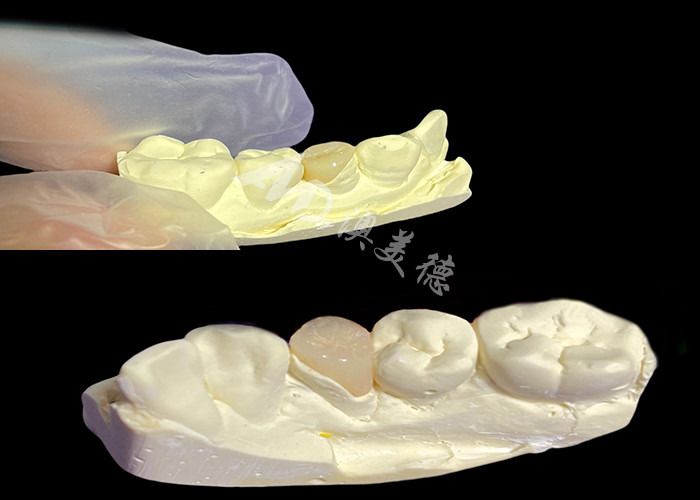 IPS e.max Các lớp phủ và lớp phủ gốm để khôi phục răng tự nhiên