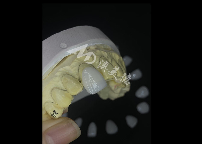 IPS e.max Veneers được chế tạo chính xác để biến đổi nụ cười không có đối thủ mang lại tính thẩm mỹ bền vững đặc biệt