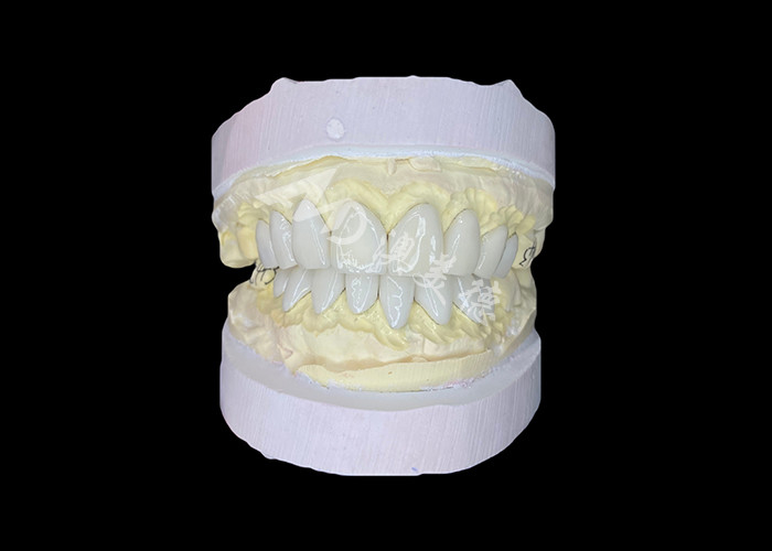 IPS e.max Veneers được chế tạo chính xác để biến đổi nụ cười không có đối thủ mang lại tính thẩm mỹ bền vững đặc biệt