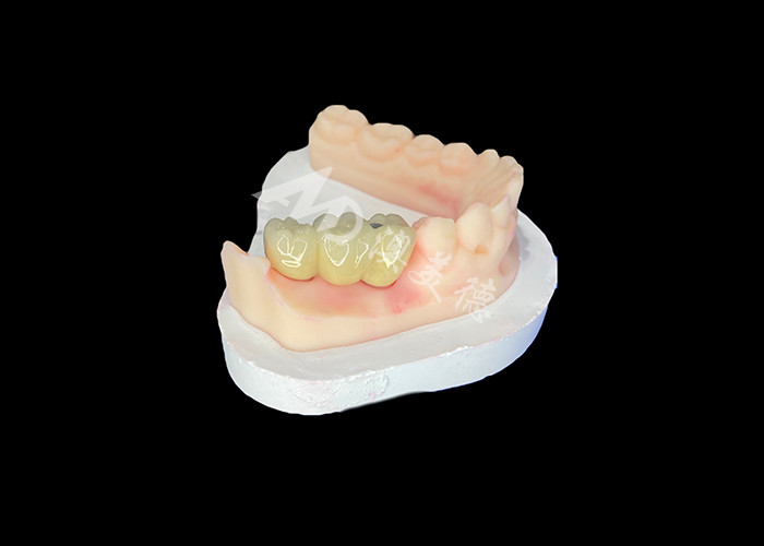 PFM Vương miện răng giống như cuộc sống và chống ăn mòn cho sức khỏe răng miệng tối ưu