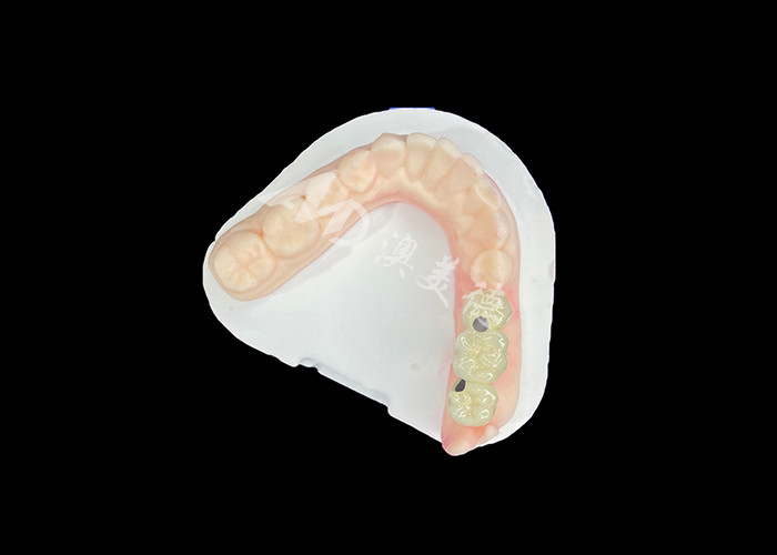 PFM Vương miện răng giống như cuộc sống và chống ăn mòn cho sức khỏe răng miệng tối ưu