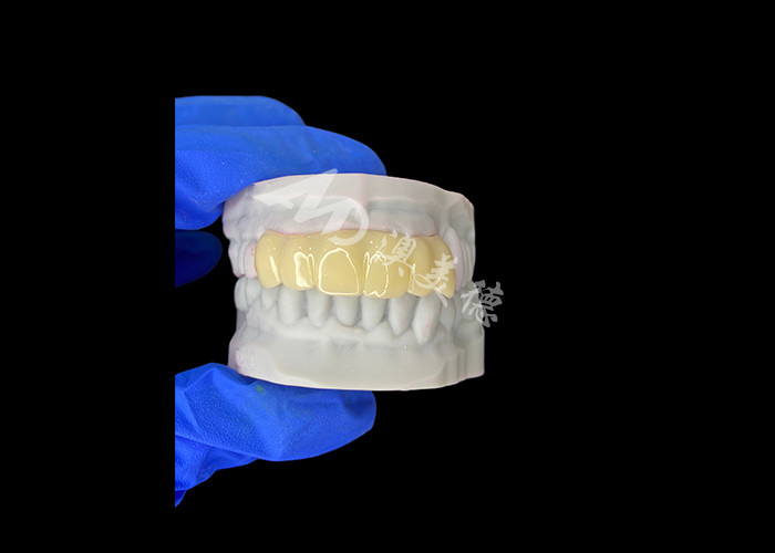 Cây cầu tạm thời rỗng in 3D tương thích sinh học nhẹ để phục hồi trước cấy ghép