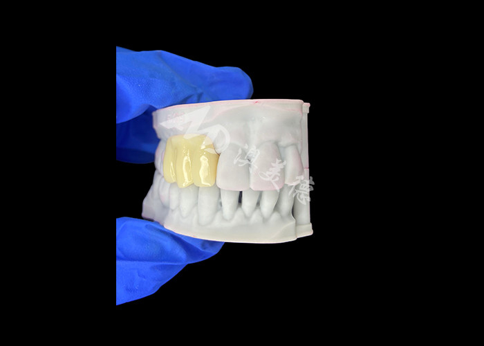 Cây cầu tạm thời rỗng in 3D tương thích sinh học nhẹ để phục hồi trước cấy ghép