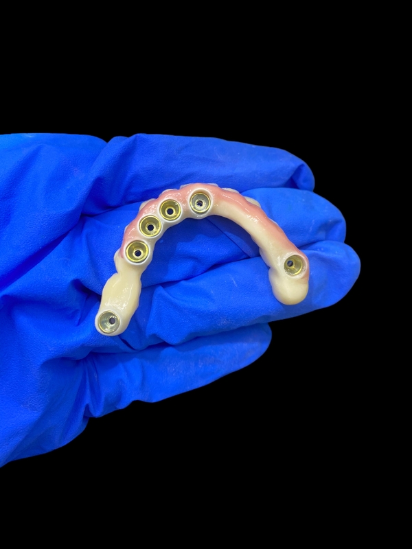 Titanium Abutment và Zirconia Crown Implant hỗ trợ răng giả chính xác phù hợp với việc mặc thoải mái