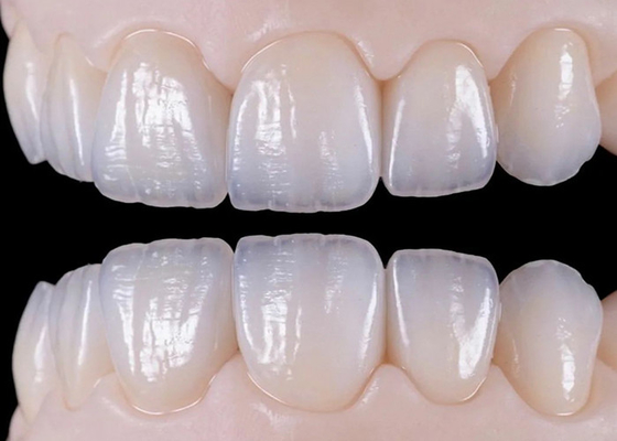 Giá tốt. Natural wear resistant ceramic dental crown bridge for lifelike restoration (Cây cầu vương miện răng gốm chống mòn tự nhiên để phục hồi giống như cuộc sống) trực tuyến
