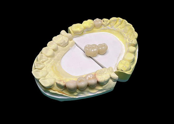 Giá tốt. Vương miện và cây cầu gốm xuyên suốt tiên tiến làm tăng nụ cười của bạn với độ chính xác và thẩm mỹ tự nhiên cho độ bền lâu dài trực tuyến