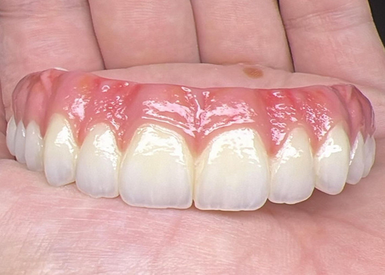 Giá tốt. Sức khỏe răng miệng Cấy ghép răng giả được hỗ trợ Đường cầu bề mặt đánh bóng hỗ trợ răng giả đầy đủ trực tuyến