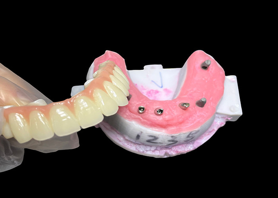 Giá tốt. Cấy ghép hỗ trợ Full Arch Denture Fixed Dental implant Ceramic Crown Bridge trực tuyến