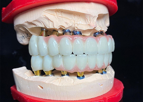 Giá tốt. Tiền Titanium đánh bóng cấy ghép răng Cây cầu vương miện gốm để phục hồi răng trực tuyến