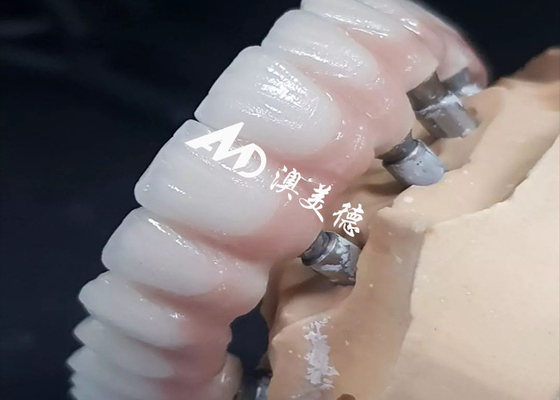 Giá tốt. Cây cấy ghép răng hiệu suất cao độc quyền Crown Bridge trực tuyến