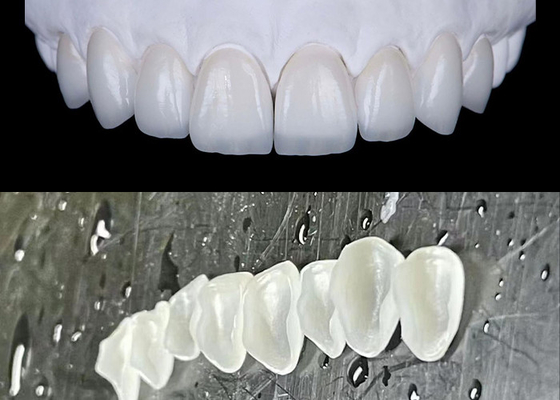 Giá tốt. IPS emax Bấm veneers sứ đạt được một nụ cười tự nhiên và tỏa sáng trực tuyến