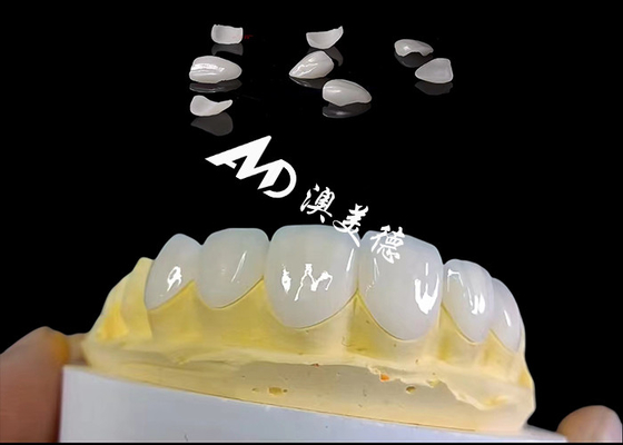 Giá tốt. Translucency IPS Emax veneers, chuẩn bị tối thiểu Emax veneers nha khoa trực tuyến