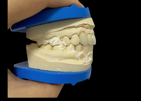 Giá tốt. Sức mạnh không thể đánh bại răng Zirconia Dentla vương miện cho nụ cười trông tự nhiên trực tuyến