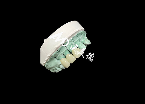 Giá tốt. Emax Ceramic Crown Giải pháp tùy chỉnh và giá cả phải chăng cho phục hồi răng trực tuyến