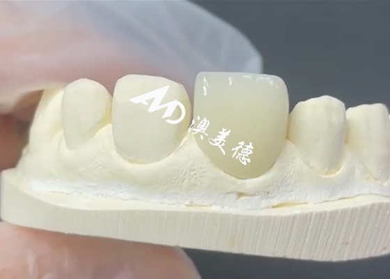 Giá tốt. EMAX veneer bền và thẩm mỹ là giải pháp hoàn hảo cho việc phục hồi đồ sứ trực tuyến