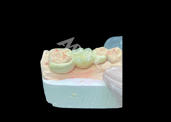 Giá tốt. Vương miện Zirconia với cầu gắn HPP để tăng thẩm mỹ nụ cười và tương thích sinh học trực tuyến