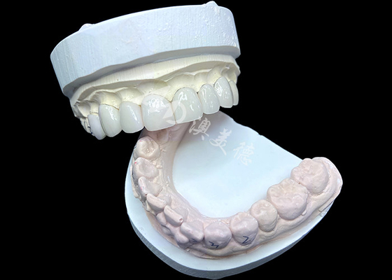 Giá tốt. IPS e.max Veneers in Shade BL2 đạt được thẩm mỹ tự nhiên tuyệt vời với 8 đơn vị được chế tạo hoàn hảo trực tuyến