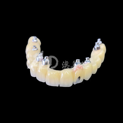 Giá tốt. Đường nối cấy ghép được giữ lại bằng vít bằng đồ sứ (PFM) trực tuyến